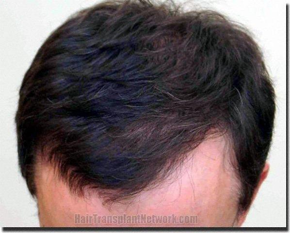 Hair restoration procedure results