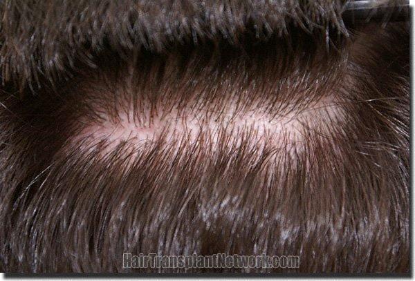 Hair restoration procedure results