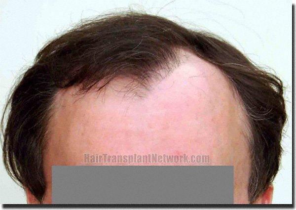 Hair restoration procedure results