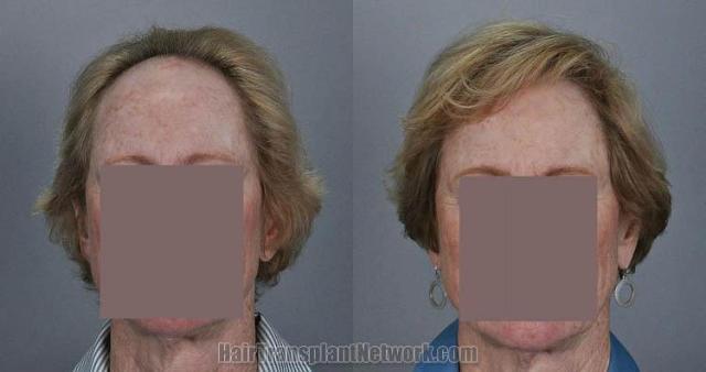 Female hair restoration procedure before and after results