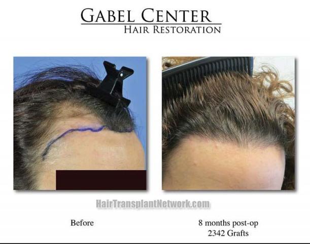 Hair restoration procedure before and after pictures