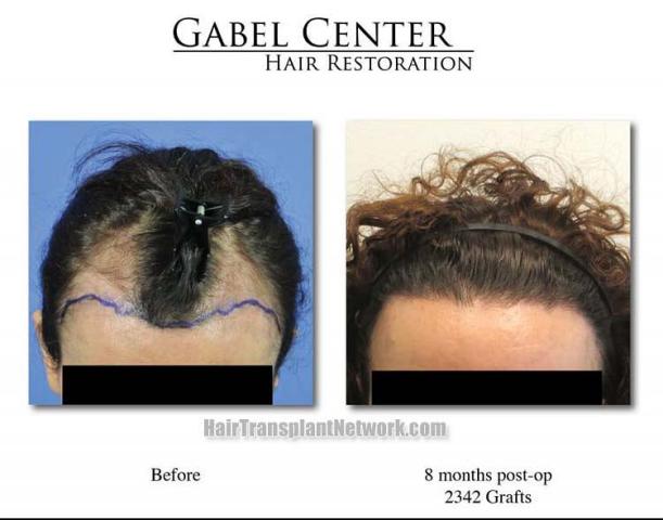 Hair restoration surgery before and after images