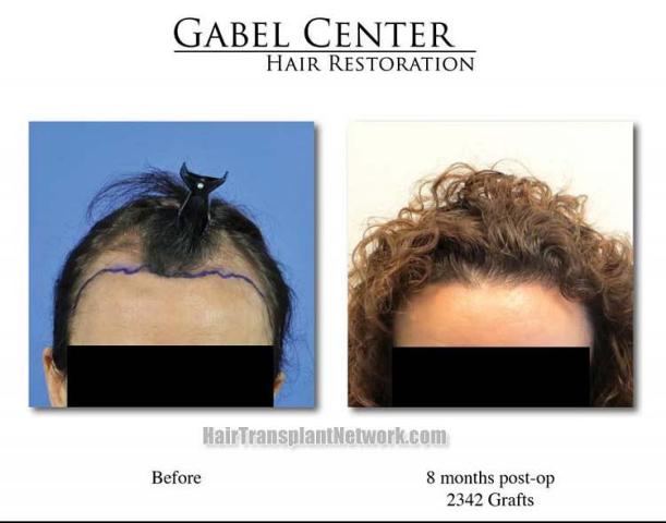 Hair restoration procedure before and after results