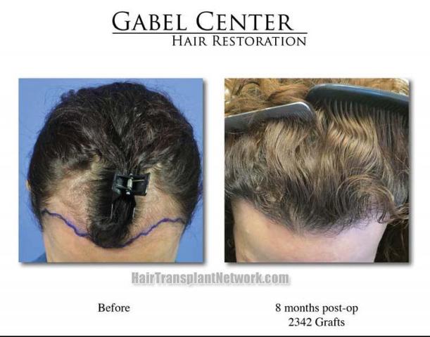 Hair transplantation surgery before and after pictures