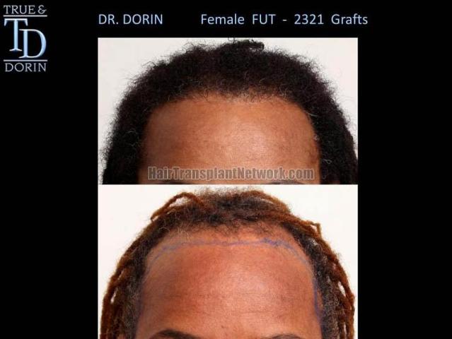 Hair restoration procedure before and after results