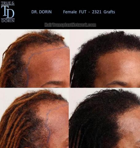 Hair transplantation surgery before and after images