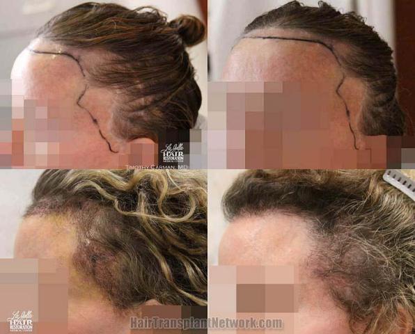 Hair transplantation surgery before and after photos