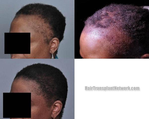 Hair transplantation surgery before and after pictures