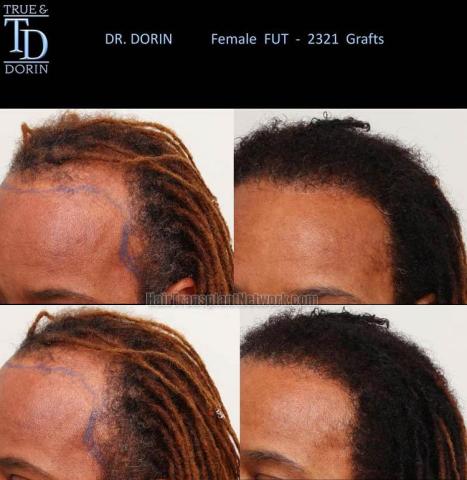 Hair transplantation surgery before and after pictures