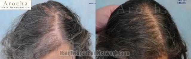 Female hair transplantation surgery result photographs