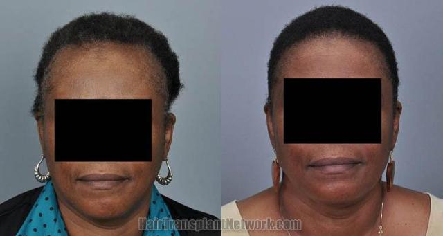 Hair restoration procedure before and after results