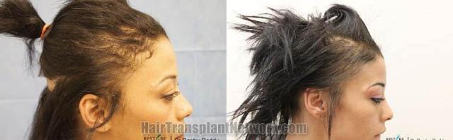 Hair restoration procedure before and after results