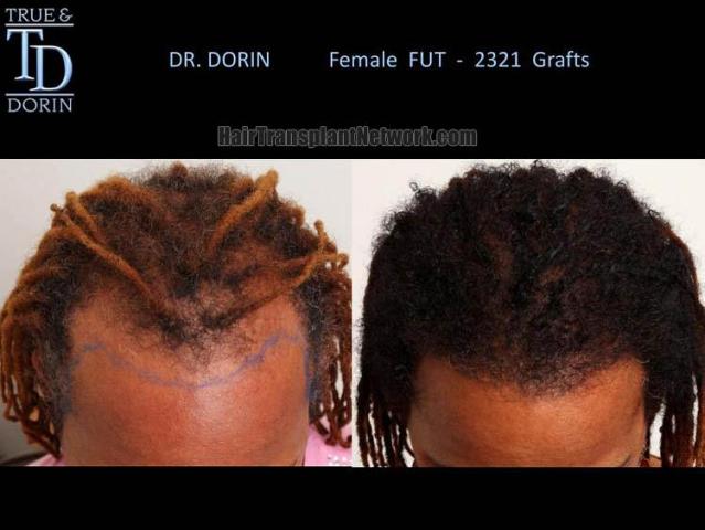 Hair transplantation surgery before and after photos