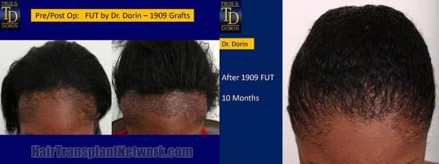 Top view - Before and after surgical hair replacement