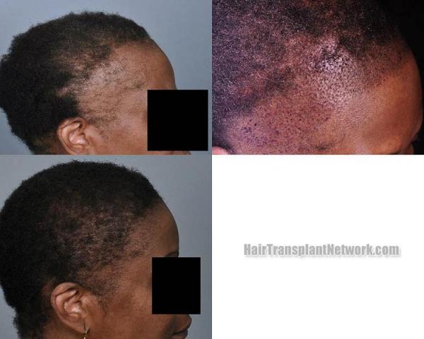 Hair transplantation surgery before and after images