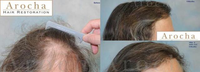 Before and after hair transplantation with a female patient