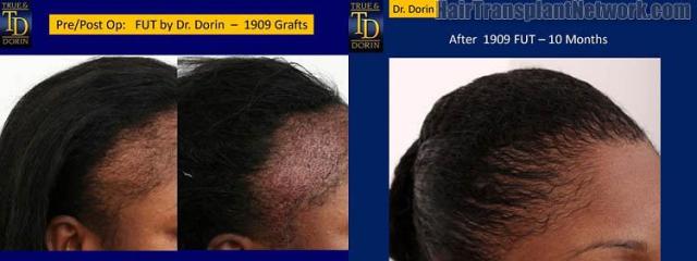 Hair restoration procedure before and after results