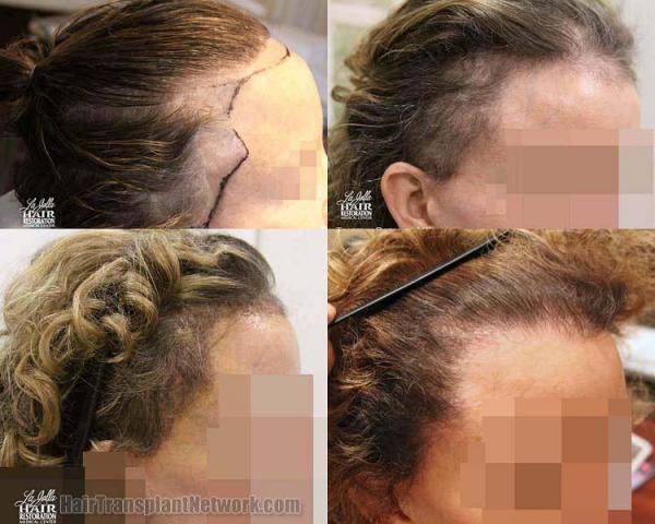 Hair restoration procedure before and after results