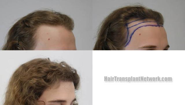 Female hair transplantation procedure before and after result