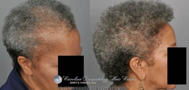 Female hair transplantation procedure before and after result