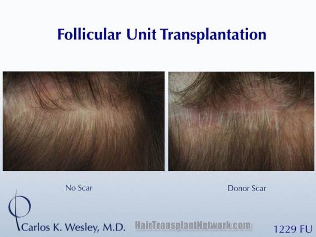 Hair replacement surgery before and after images