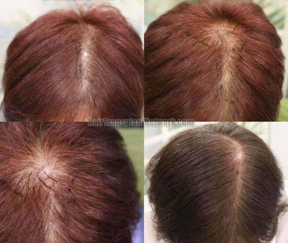 Female hair restoration  before and after photos