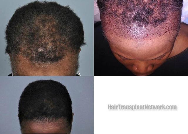 Hair transplantation surgery before and after photos