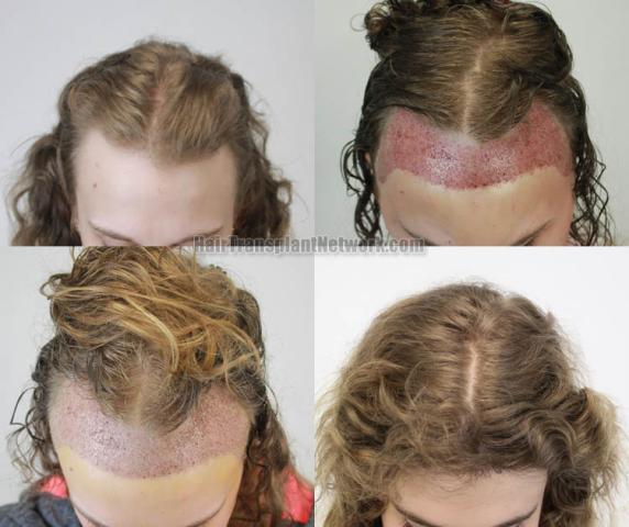 Female hair transplantation surgery before and after images