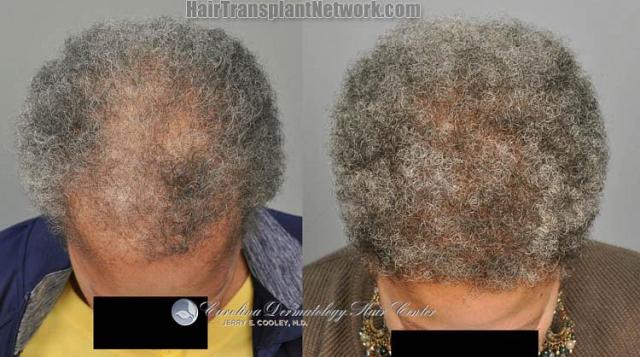 Female hair transplantation surgery before and after images