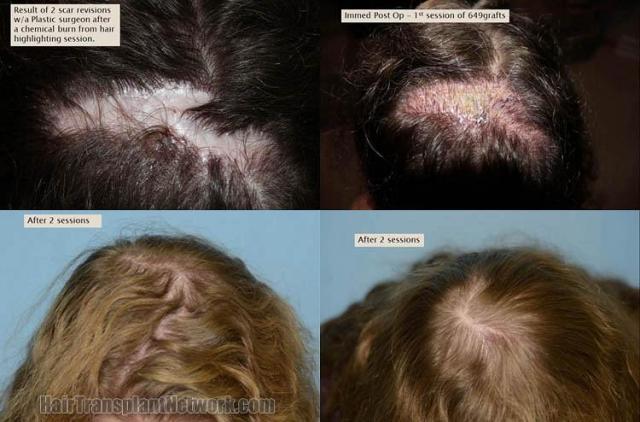 Hair transplantation surgery before and after photos