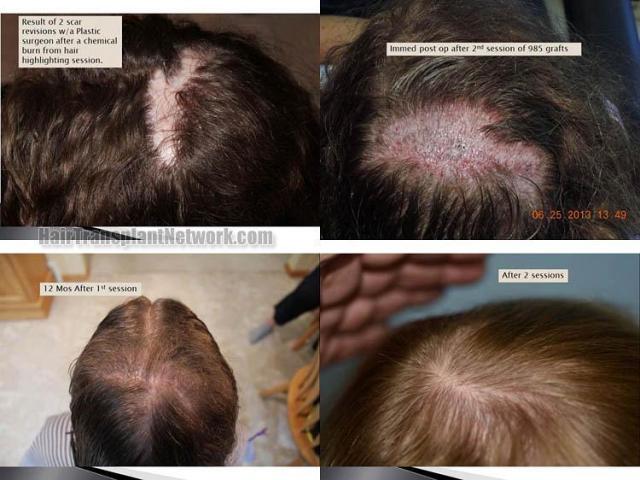 Hair restoration procedure before and after results