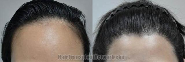 Hair restoration procedure before and after results