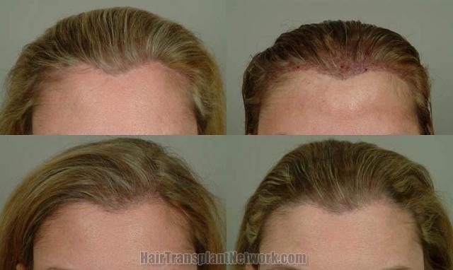 Hair transplantation surgery before and after pictures