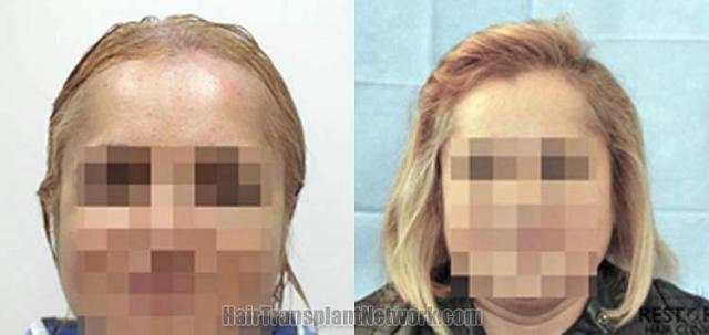 Hair restoration procedure before and after results