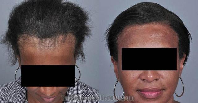 Hair restoration procedure before and after results