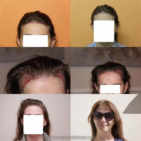 Hair transplantation surgery before and after photos