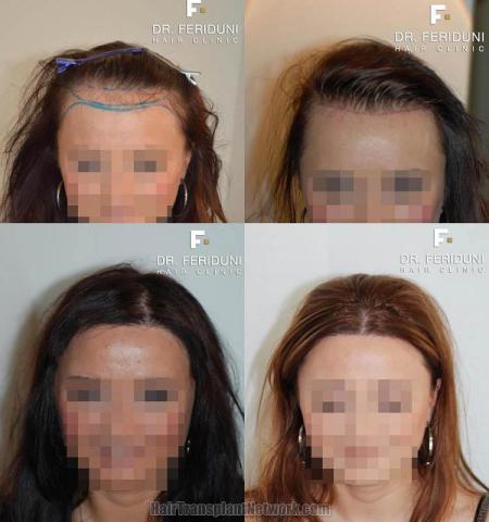 Hair transplantation surgery before and after images