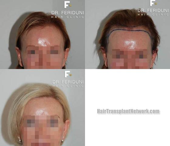 Hair restoration procedure before and after results