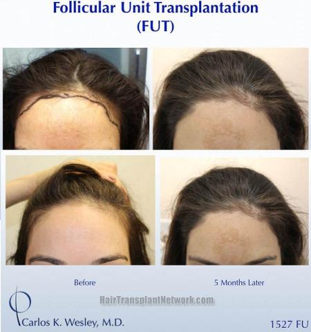 Female hair restoration procedure before and after results