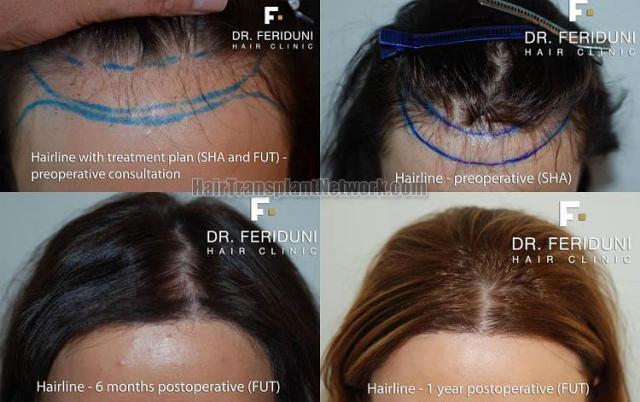 Hair transplantation surgery before and after pictures