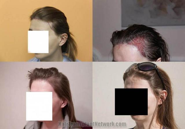 Hair transplantation surgery before and after pictures