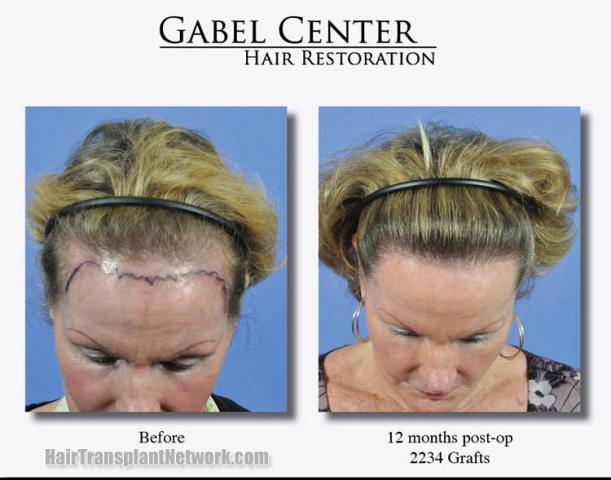 Before and after hair transplant procedure images