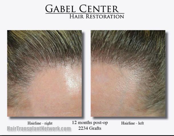 Hair transplantation surgery before and after pictures