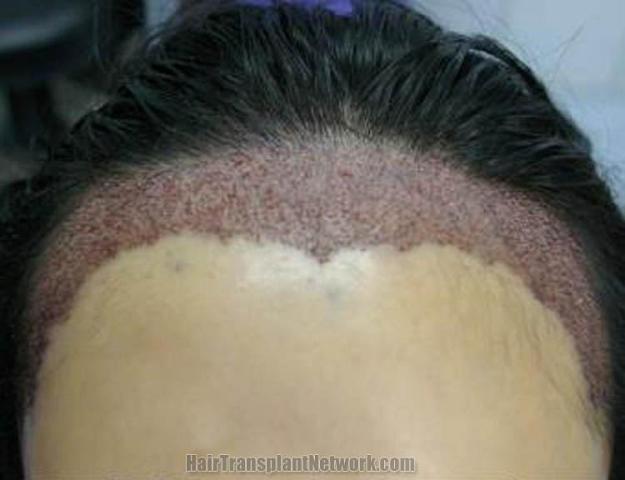 Hair transplantation surgery immediate postoperative