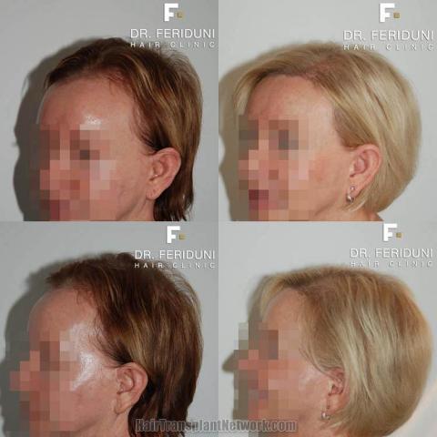 Hair transplantation surgery before and after pictures