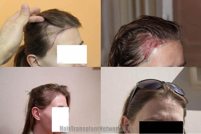 Hair transplantation surgery before and after images