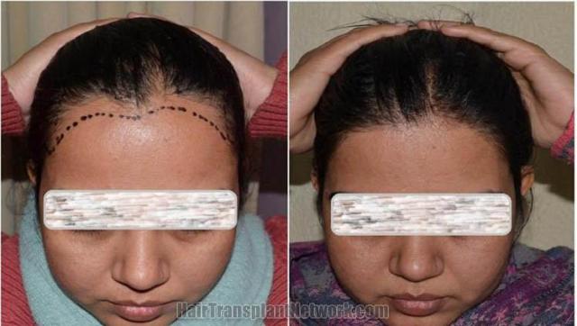 Female hair transplantation surgery before and after photos