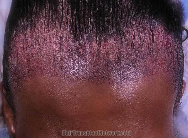 Hair transplantation surgery before and after photos