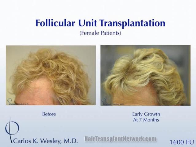 Hair transplantation surgery before and after images