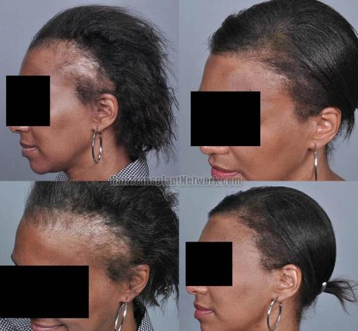 Hair transplantation surgery before and after pictures